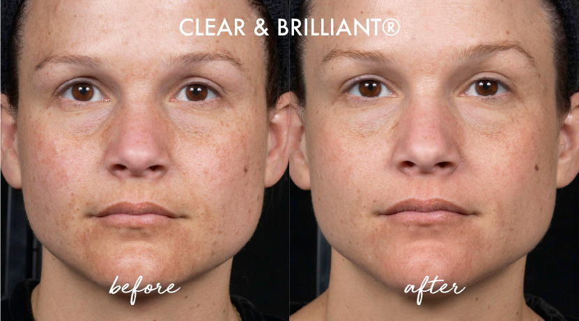 Clear and Brilliant before and after