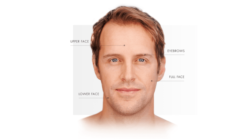 Diagram of man showing treatable areas for Ulthera which are: upper face, eyebrows, full face, and lower face.