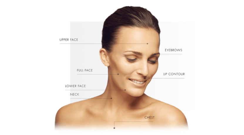 Diagram of woman showing treatable areas for Ulthera which are: upper face, eyebrows, full face, lip contour, lower face, neck, and chest.
